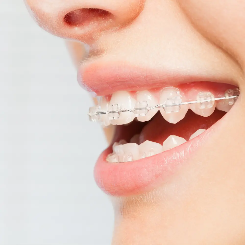 Clear Brackets